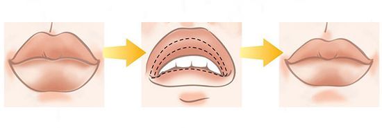 Уменьшение верхней губы или укорачивающая хейлопластика