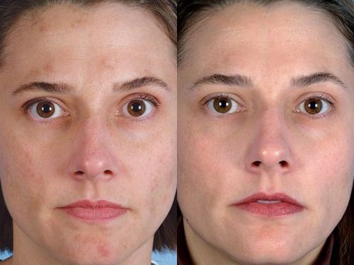 Эффект после ультразвуковой чистки лица фото до и после