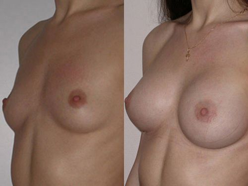 Увеличивающая маммопластика фото до и после